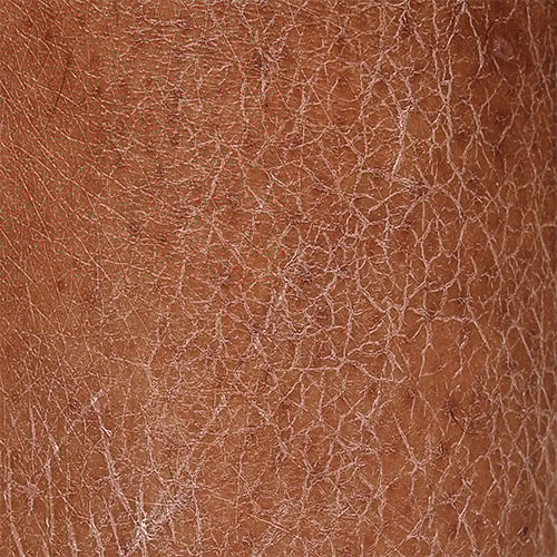 Close up of dry skin before CeraVe skin barrier products applied